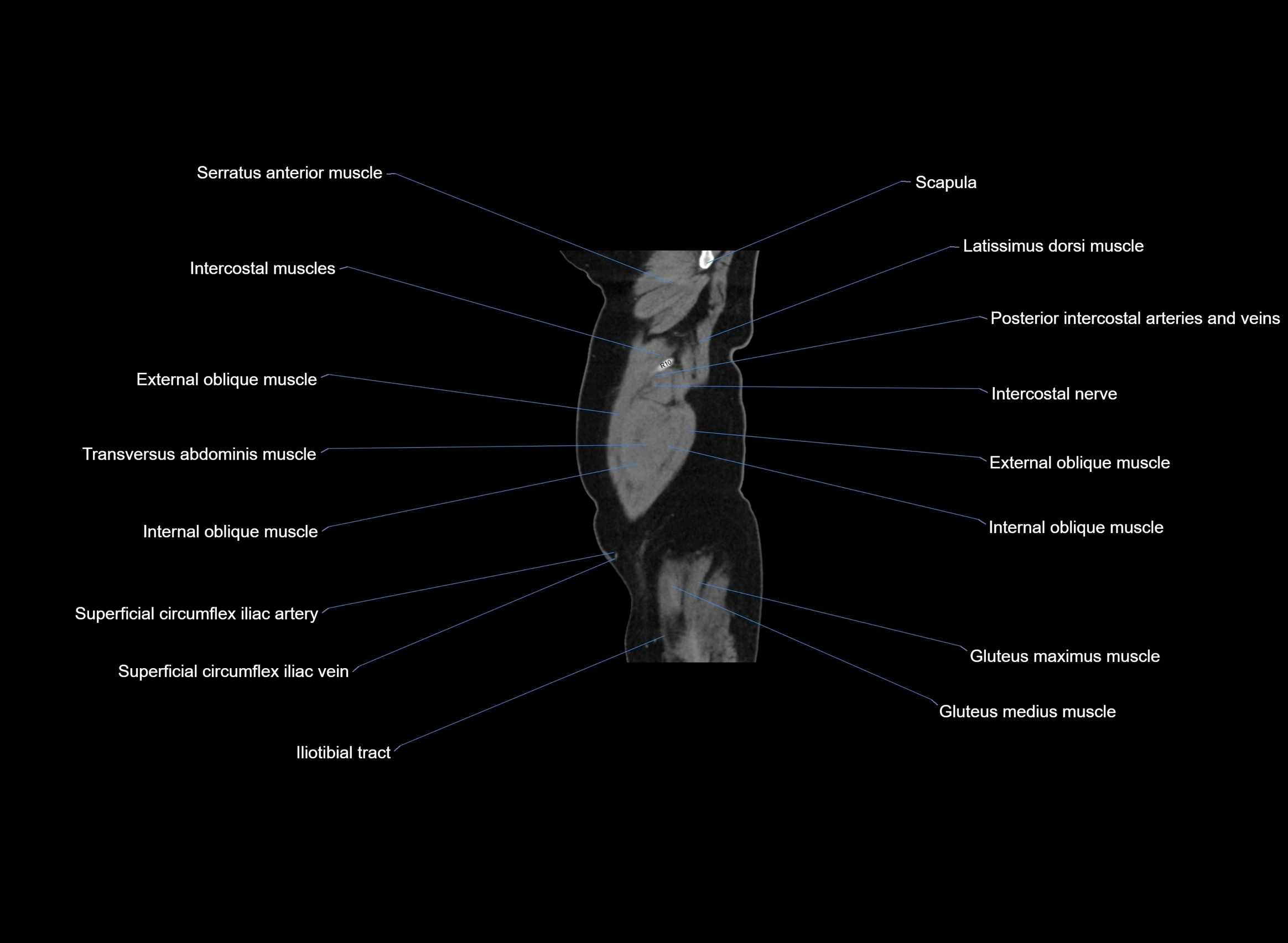 CT Abdomen sagittal cross sectional anatomy labelled radiology image -00106.webp